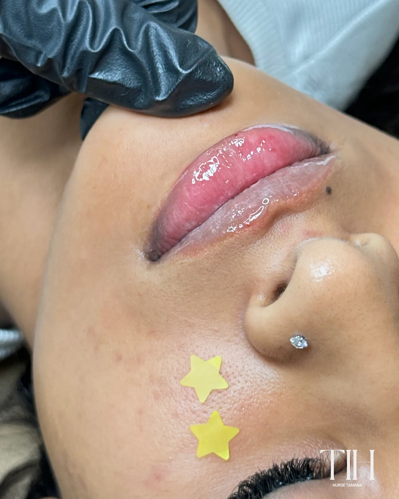 Close-up of a lip filler injection during treatment