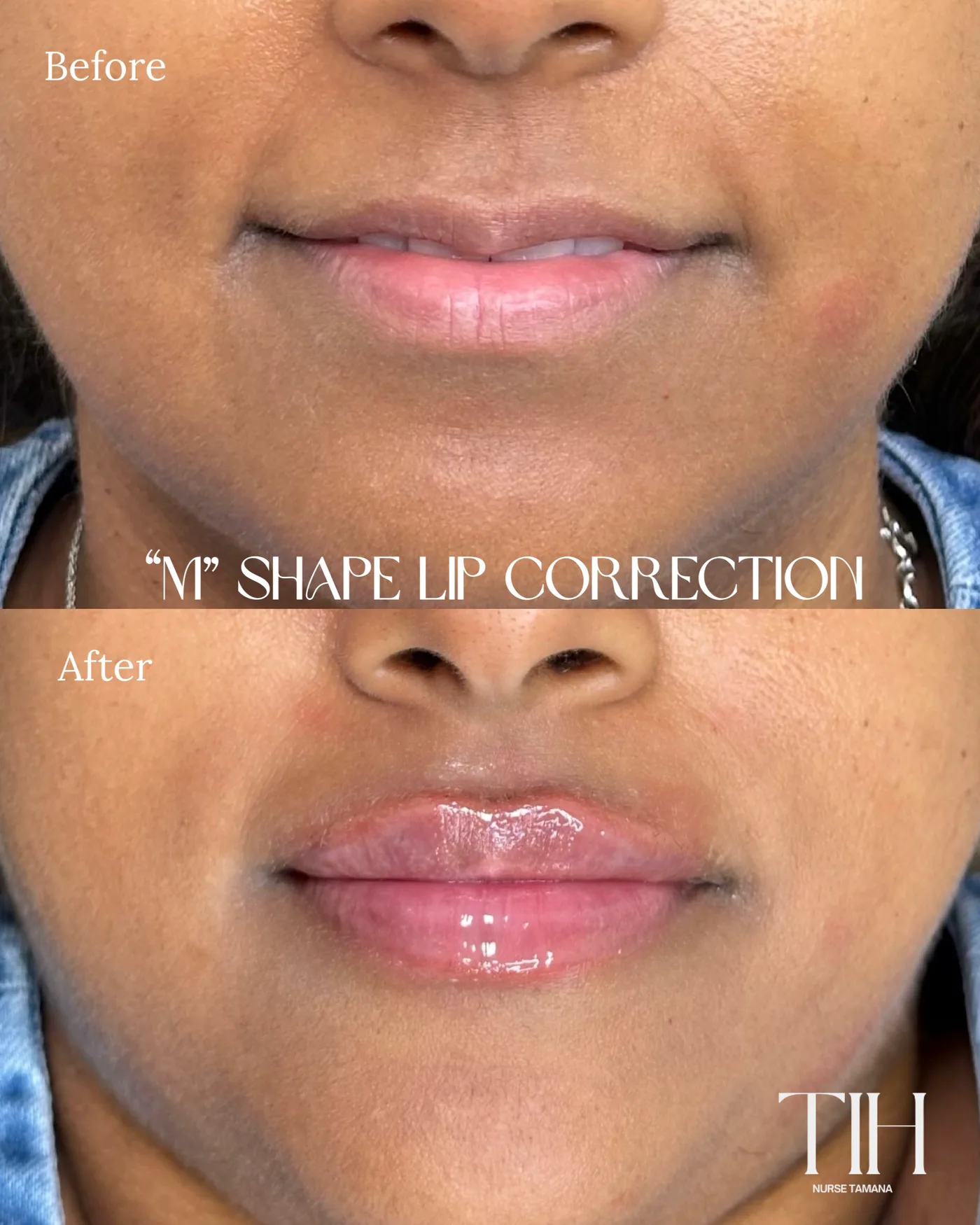 Before and after M-shape lip correction — refined cupid's bow and even volume