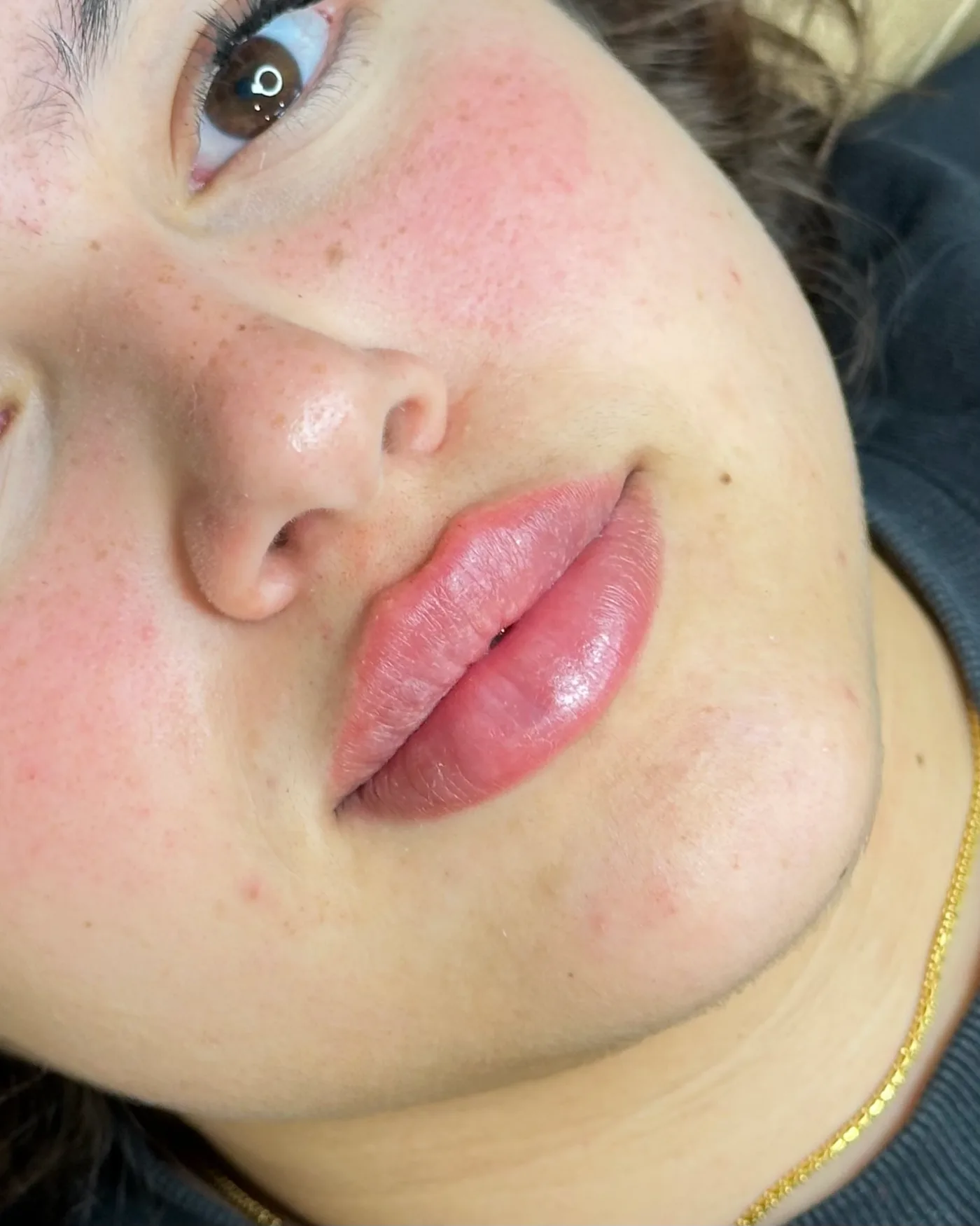 Close-up of natural-looking lip filler results