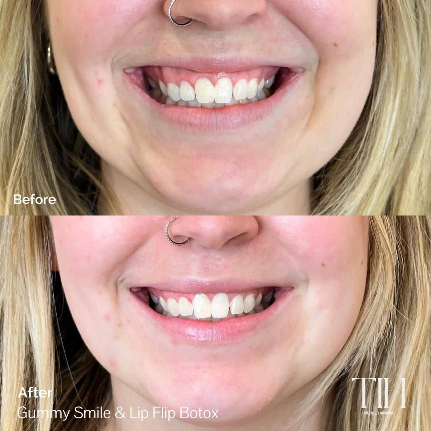 Before and after gummy smile and lip flip Botox — balanced, natural smile line