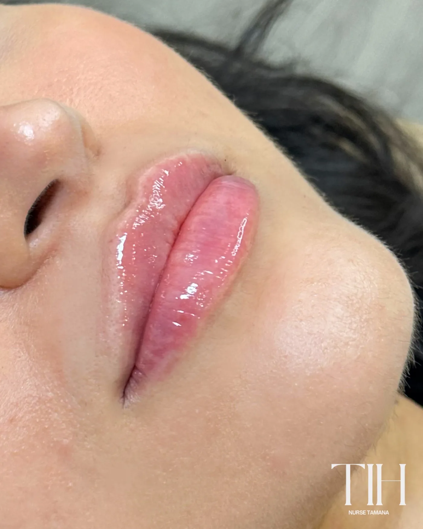 Close-up of full, glossy lips after filler