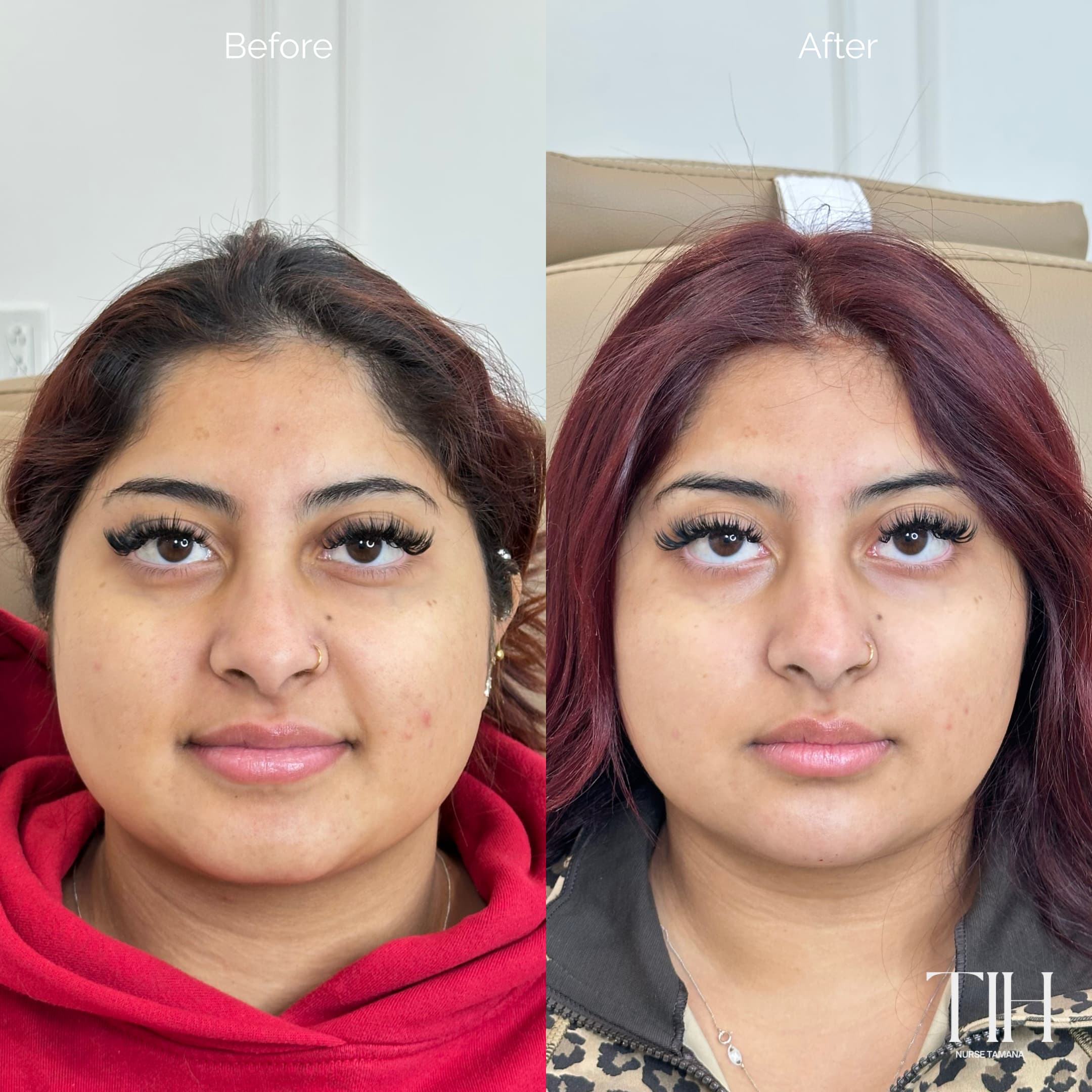 Before and after masseter Botox — softened lower-face width