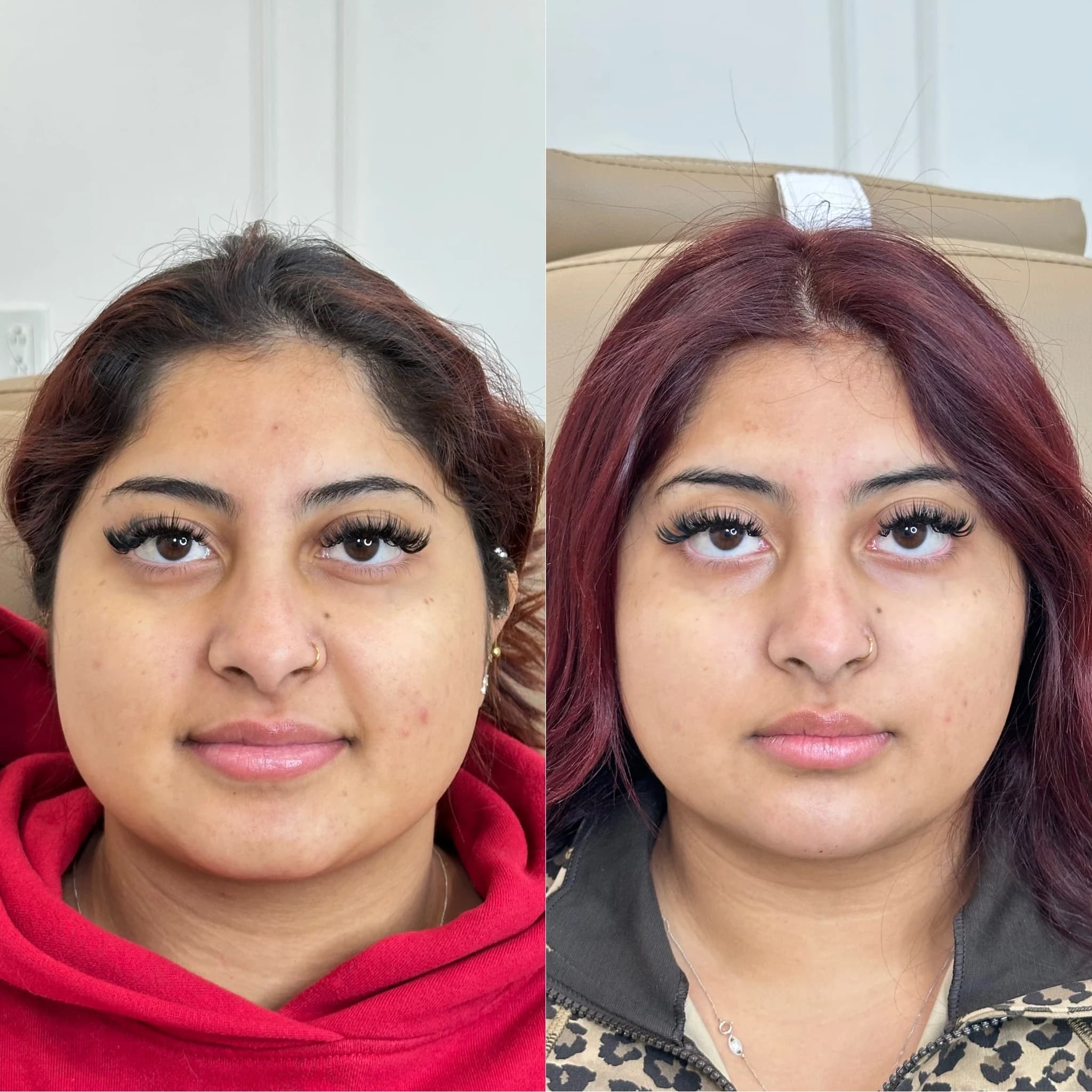 Masseter Botox at The Injectable Haus