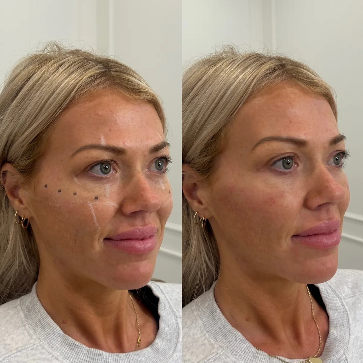 Before and after cheek filler — midface support and soft contour