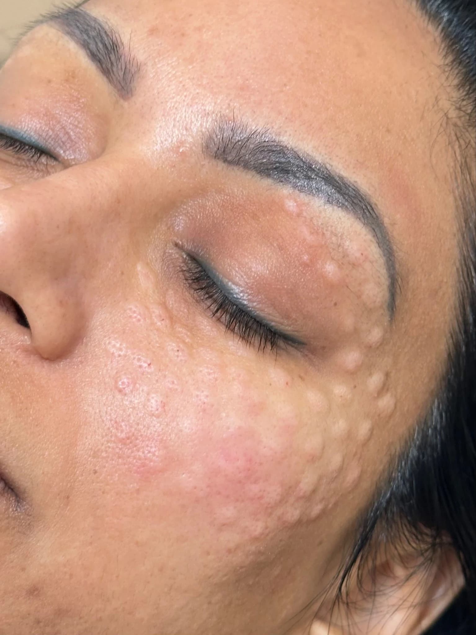 NCTF 135 HA Skin Booster at The Injectable Haus