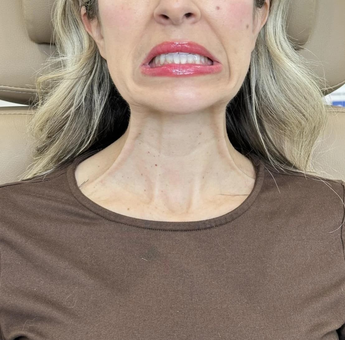 Neck Botox / Platysmal Bands at The Injectable Haus