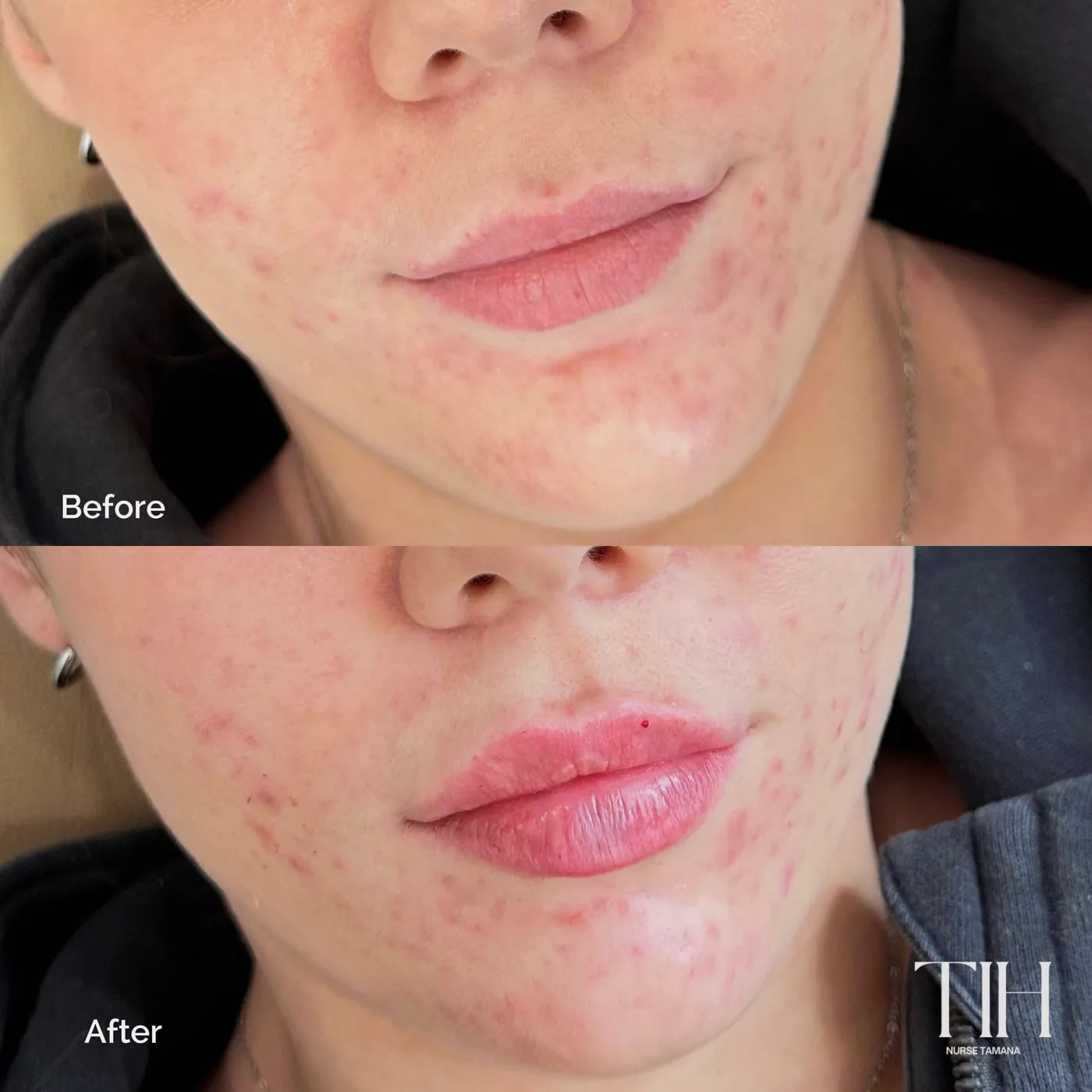 Before and after skin treatment — calmer, smoother skin texture